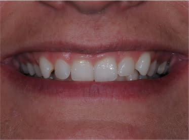 before image of dental implant patient 