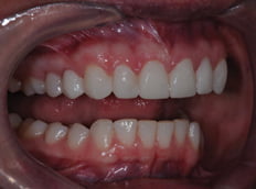 after result of patient dental implant procedure