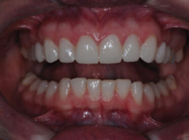 After - Birmingham Dental