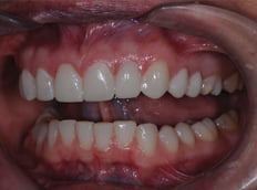 After - Birmingham Dental