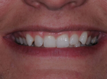 Before - Birmingham Dental