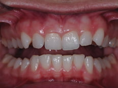 Before - Birmingham Dental