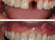 before and after image of dental implant done by Amit Patel