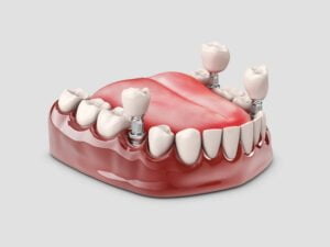 image of dental implant