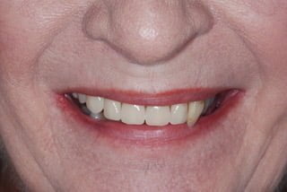 patient before dental implant
