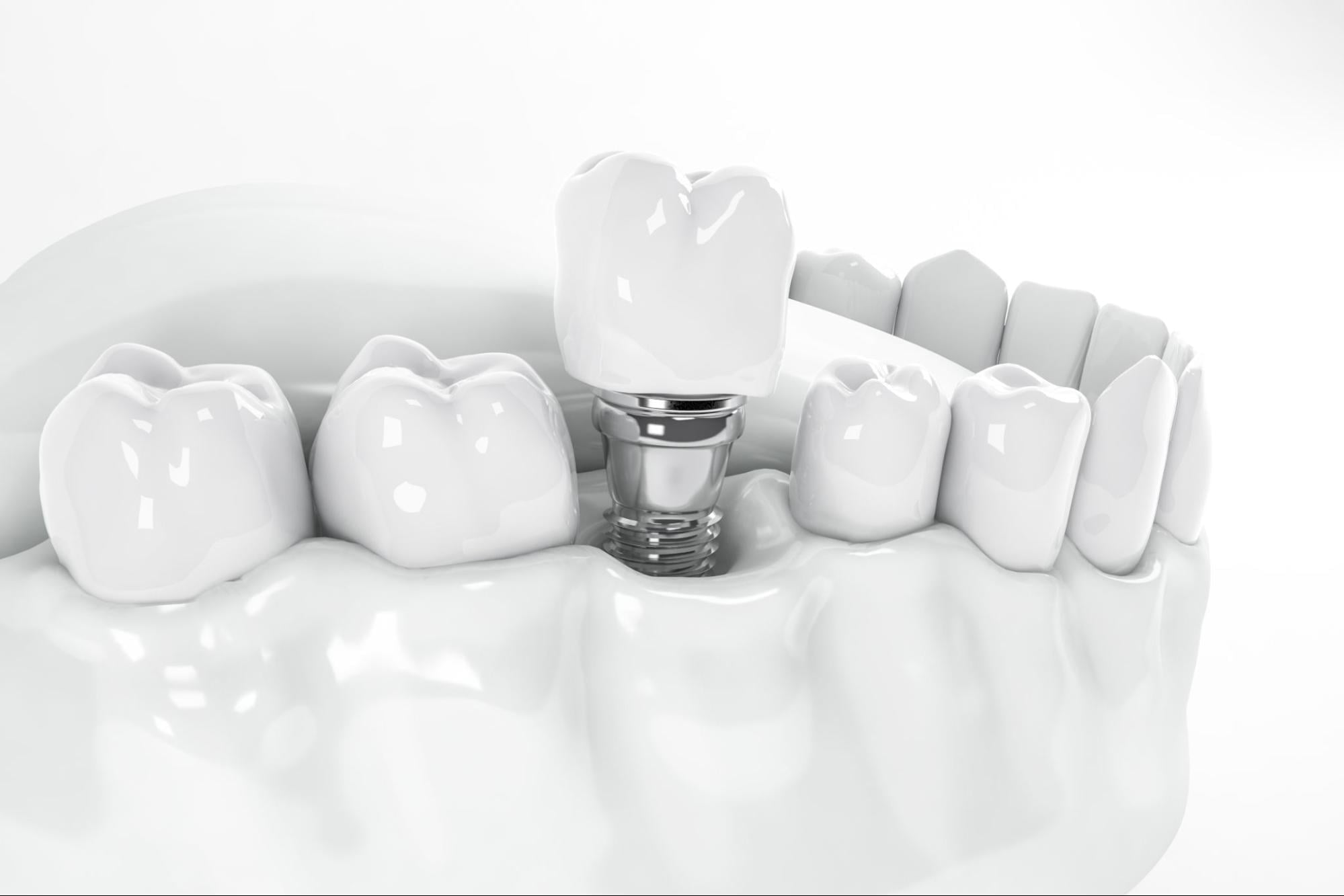 infographic of dental implant