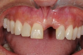 patient teeth before implant