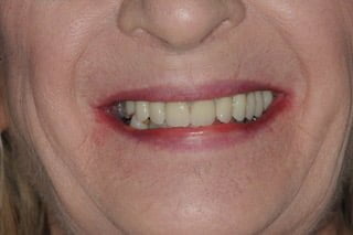 patient after dental implant