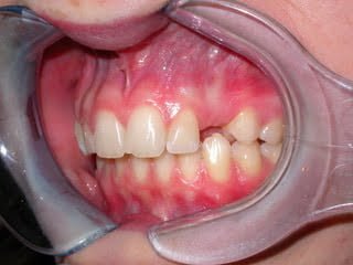 patient showing teeth before implant