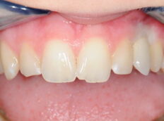close up of patient teeth top row