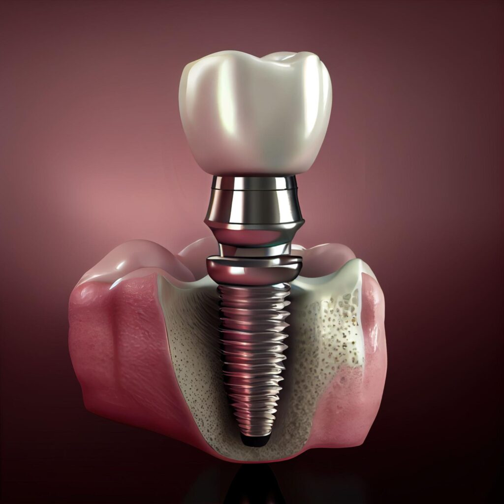 illustration of a dental implant