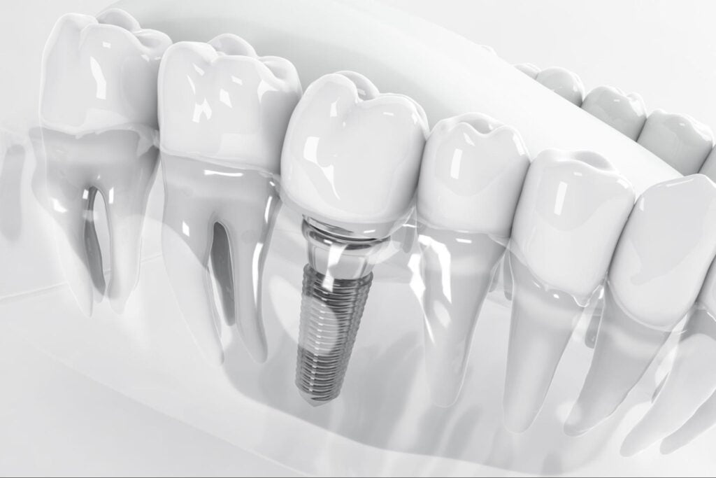 dental implant representation