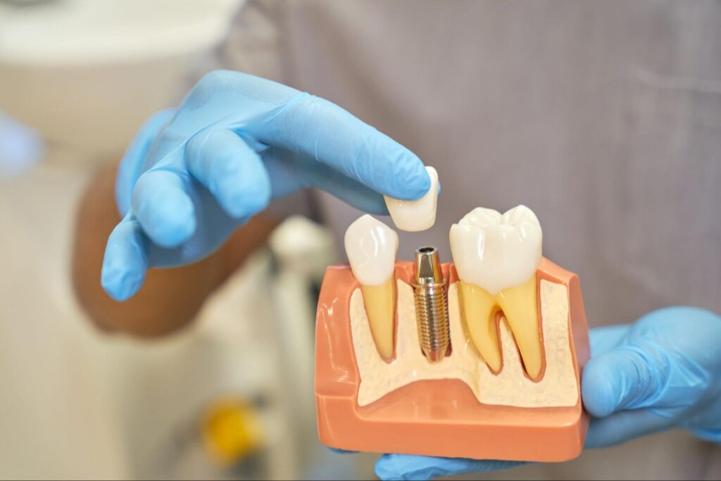 dental implant prop