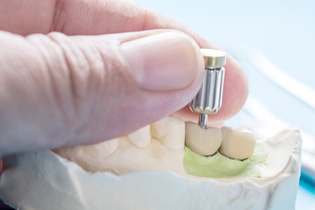 mini dental implants