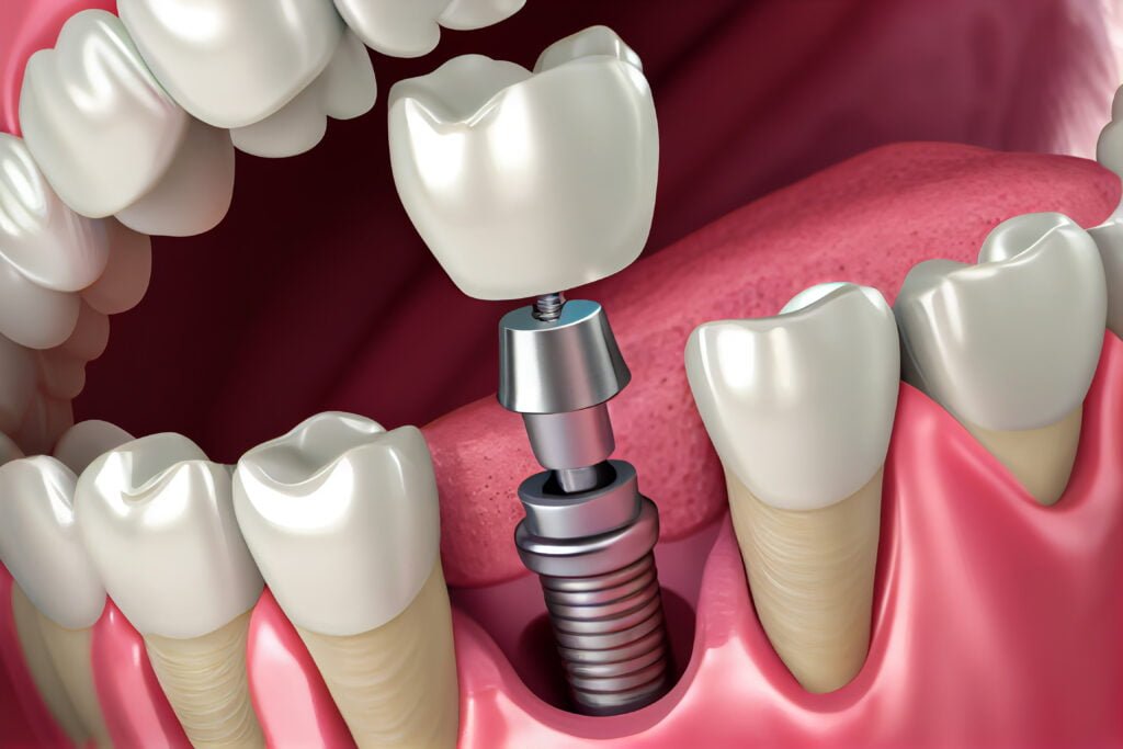 all on 4 dental implant infographic 
