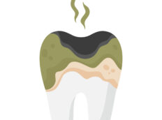 Root tooth