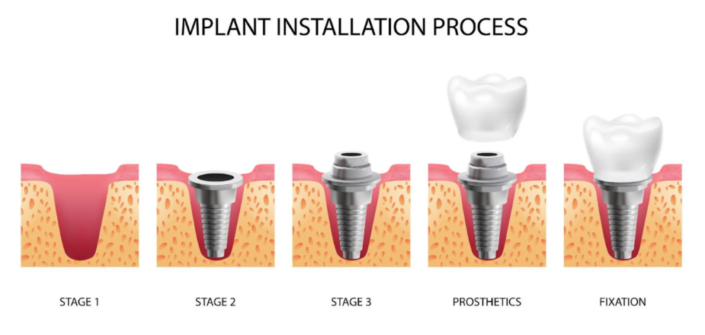 Implant step-by-step process 